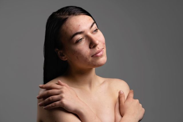 trądzik zimą co robić